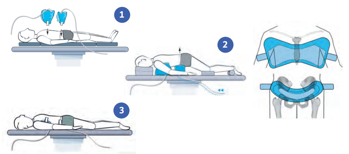 Posicionamiento decúbito-prono
con un soporte activado mediante aire comprimido